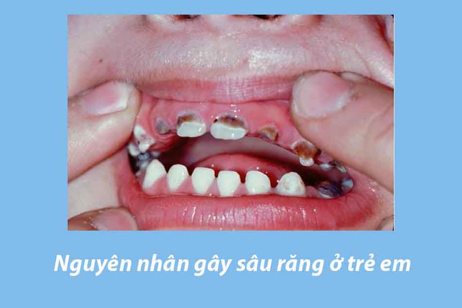 Nguyên nhân gây sâu răng ở trẻ em
