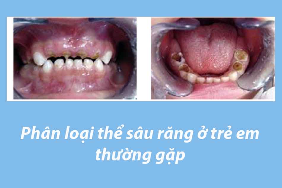 Phân loại thể sâu răng ở trẻ em thường gặp