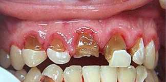 Kháng thể IgY và bệnh răng lợi
