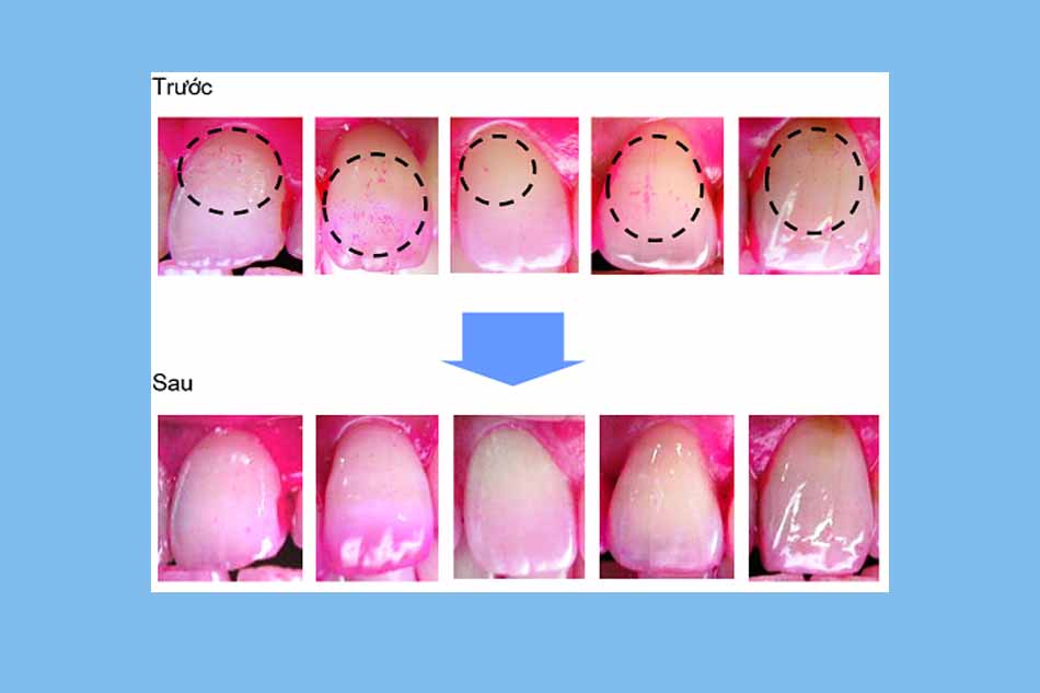 Hình ảnh răng với mảng bám trên răng trước và sau điều trị