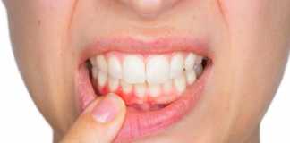Nghiên cứu tác dụng Ovalgen PG trên bệnh quanh răng