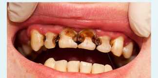 Bệnh sâu răng có nguy hiểm không?
