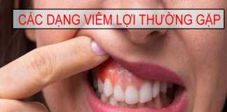 Các dạng viêm lợi thường gặp