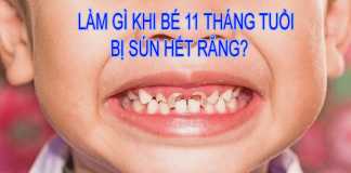 Làm gì khi bé 11 tháng tuổi bị sún hết răng?