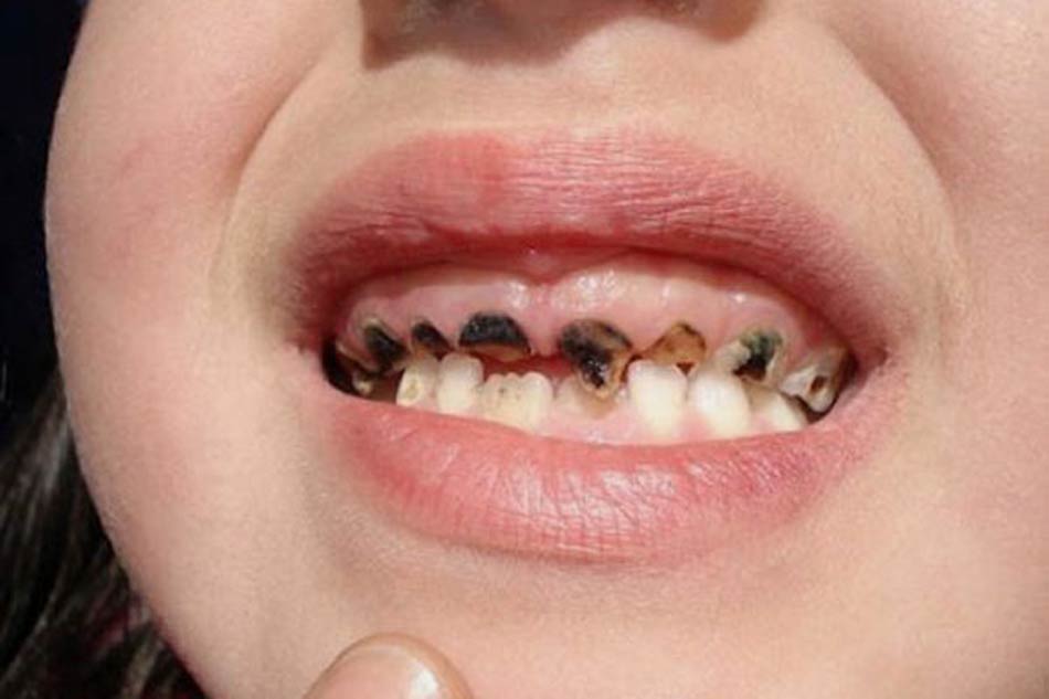 Làm gì khi trẻ bị sâu răng, sún răng? (Ảnh minh họa)