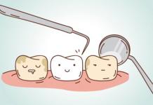Mảng bám răng là nguyên nhân trực tiếp dẫn đến các bệnh về răng lợi.