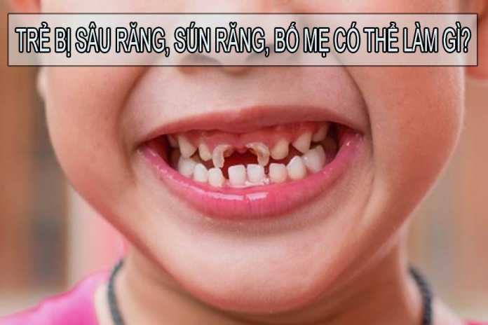 Trẻ bị sâu răng, sún răng, bố mẹ có thể làm gì?