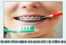 Vệ sinh răng miệng khi mang mắc cài chỉnh nha