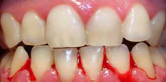 Viêm lợi chảy máu chân răng
