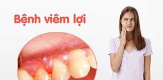 Có phải bạn đang bị viêm lợi? (Ảnh minh họa)