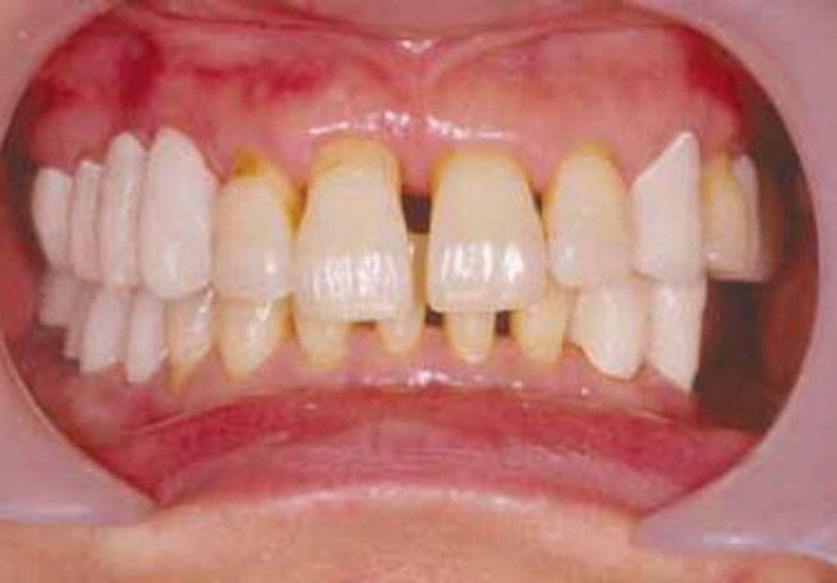 Kẽ hở rộng giữa chân răng báo hiệu tình trạng viêm lợi. (Ảnh minh họa)