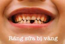Răng sữa tự nhiên của trẻ có màu trắng ngà, vì vậy nếu răng sữa bị ố vàng cha mẹ cần đặc biệt lưu tâm tìm ra nguyên nhân, bảo vệ sức khoẻ răng miệng cho trẻ.