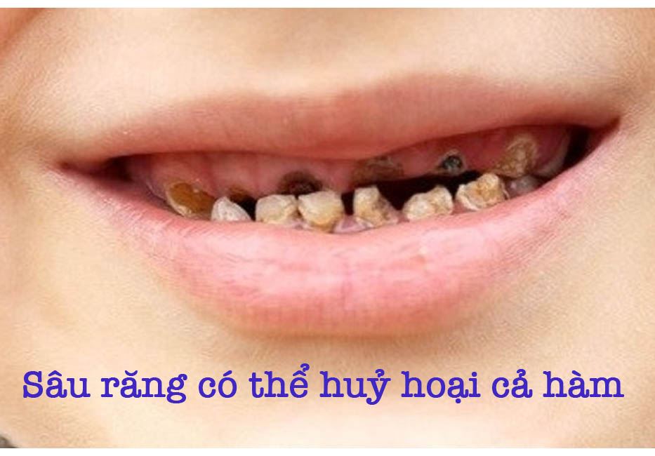 Sâu răng có thể hủy hoại cả hàm răng