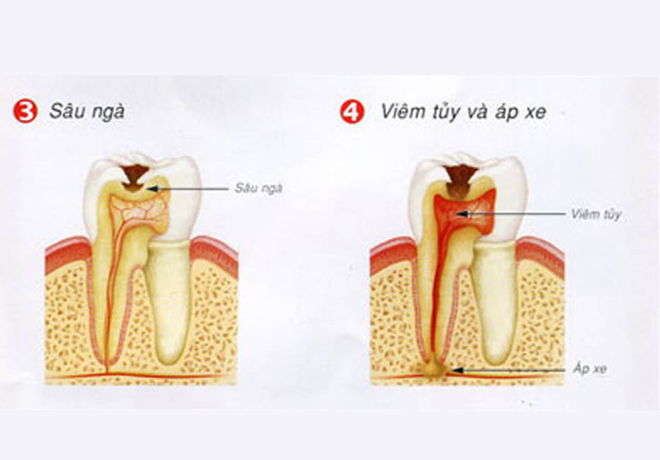 Hình ảnh răng bị tổn thương ở lớp ngà