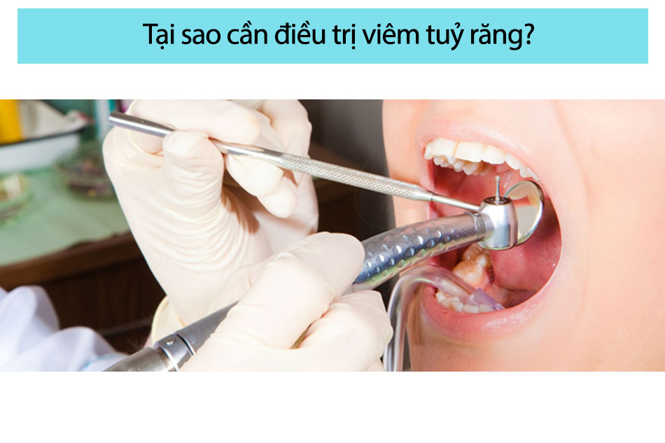 Tại sao cần điều trị viêm tuỷ răng? 1