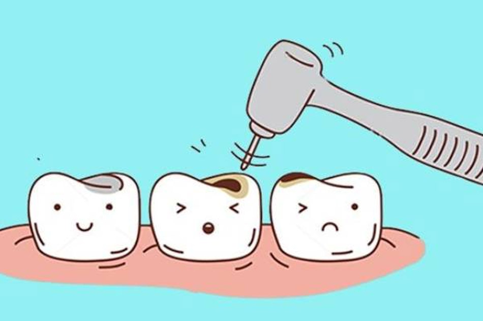 Sâu răng sữa sớm: Mối nguy hiểm cha mẹ không hề biết 3