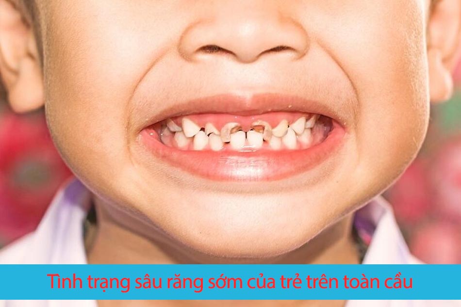 Sâu răng sữa sớm: Mối nguy hiểm cha mẹ không hề biết 2