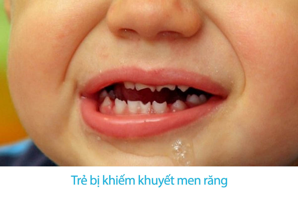 Cách xử lý khi trẻ bị đa sâu răng sớm 1