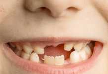 Sâu răng rất thường hay gặp ở trẻ nhỏ