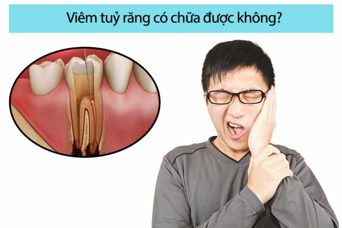 Viêm tuỷ răng có chữa được không?